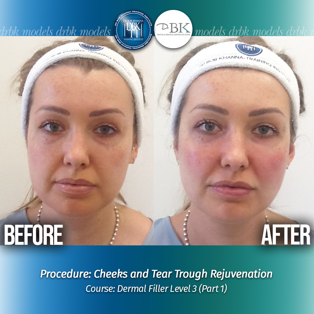 Cheeks and TT Augmentation - DrBKTI Model