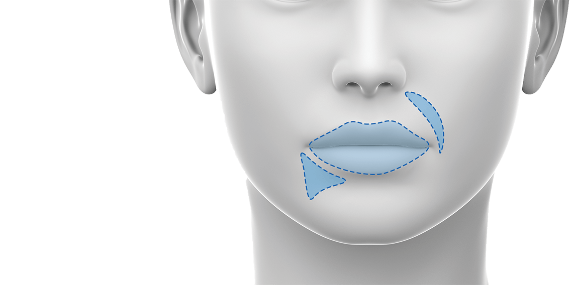 Dermal filler for the lips - training