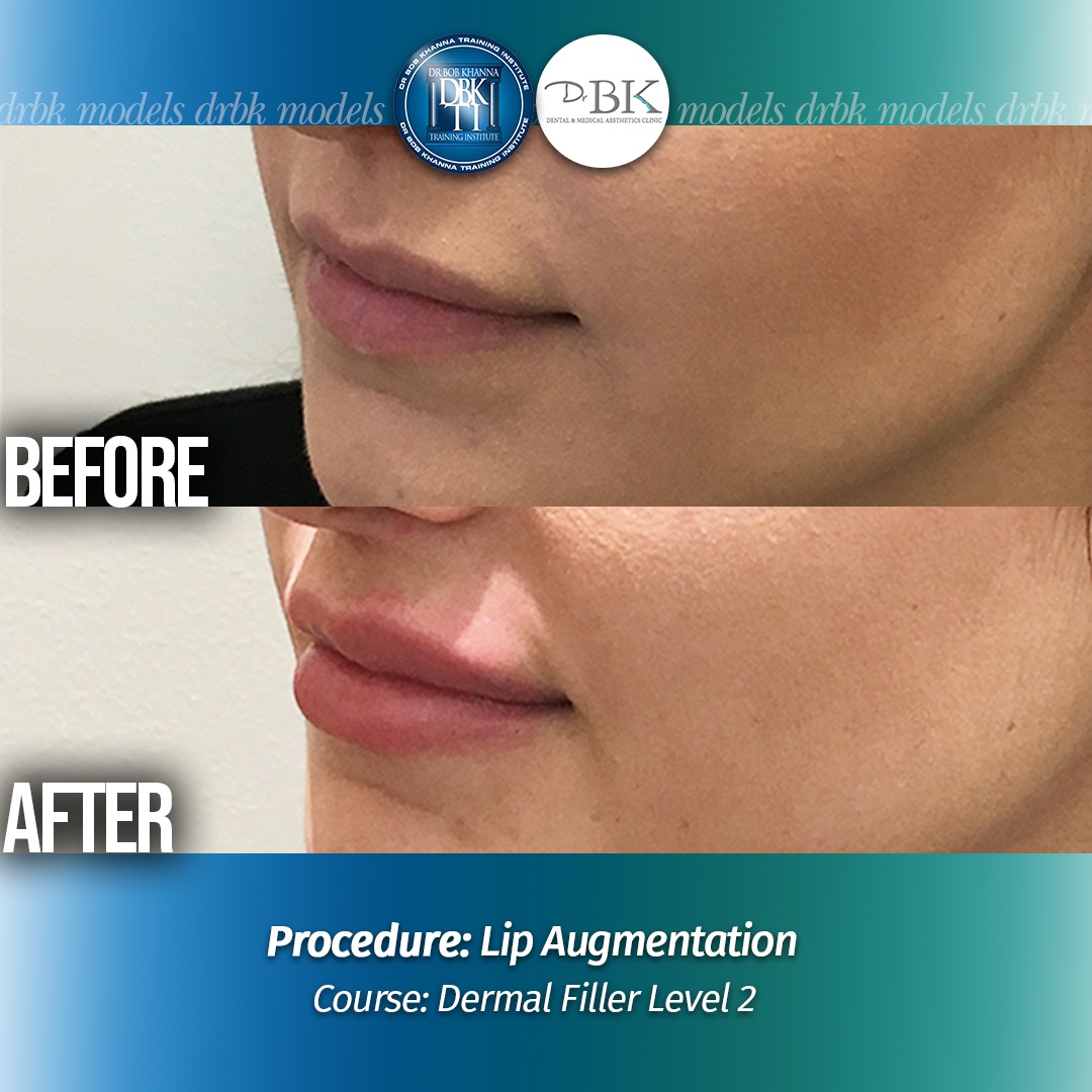 Lip Augmentation - DrBKTI Model