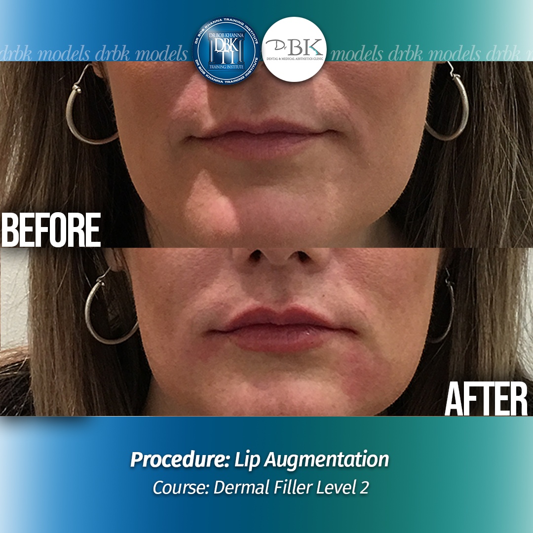 Lip Augmentation - DrBKTI Model
