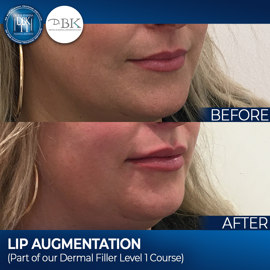 Lip Augmentation - DrBKTI Model