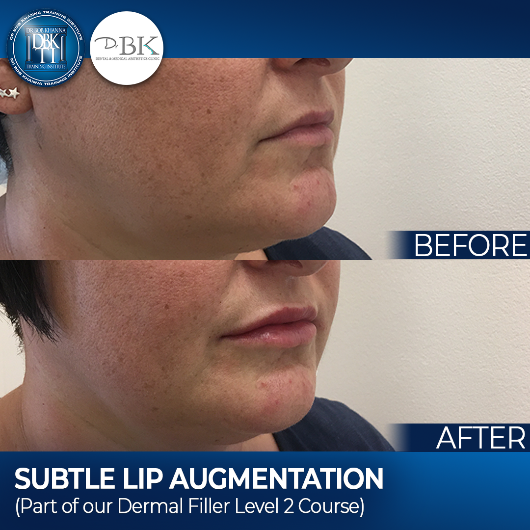 Lip Augmentation - DrBKTI Model