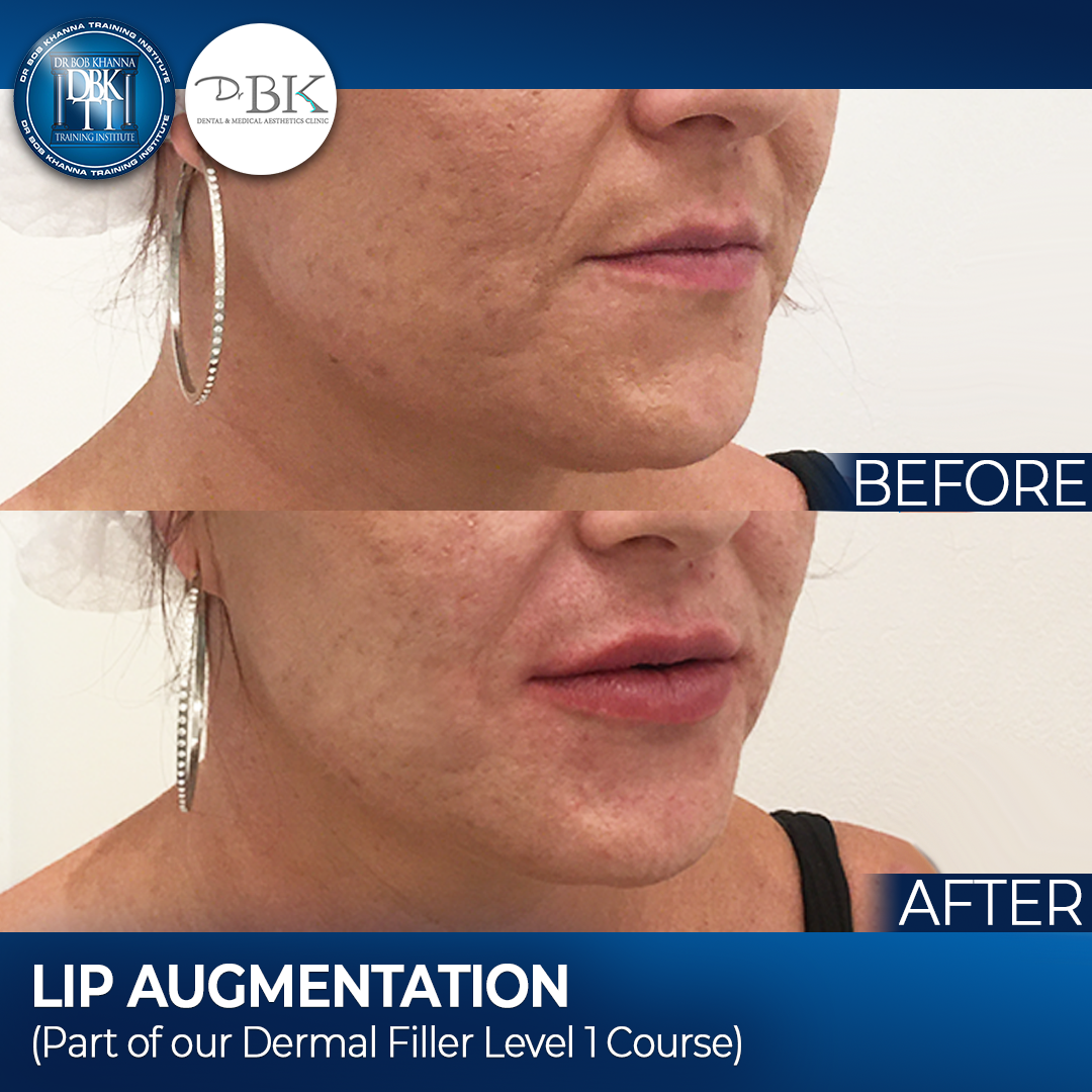 Lip Augmentation - DrBKTI Model
