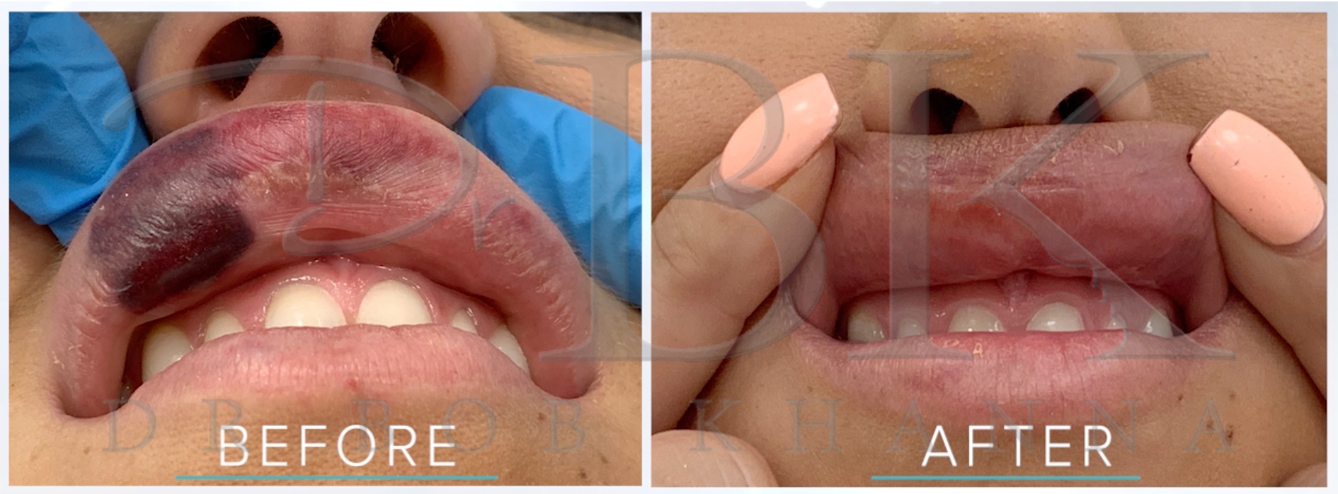 Why you should only get filler done by a Medical Professional: Botched Filler Before & After